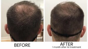 Exosome Hair Restoration - Taylor Plastic Surgery Exosome Hair Restoration - Taylor Plastic Surgery