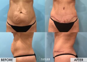 Reverse Tummy Tuck Case #4180 - Dr. Nealy, DO